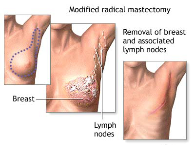 Breast Cancer Surgery in India